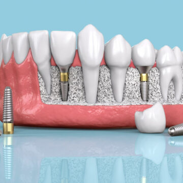 Dental Implants in Largo