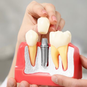 When Are Dental Implants Medically Necessary?