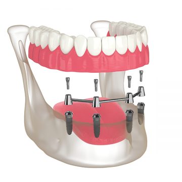 All-on-4 Dental Implants: A Permanent Solution for Missing Teeth