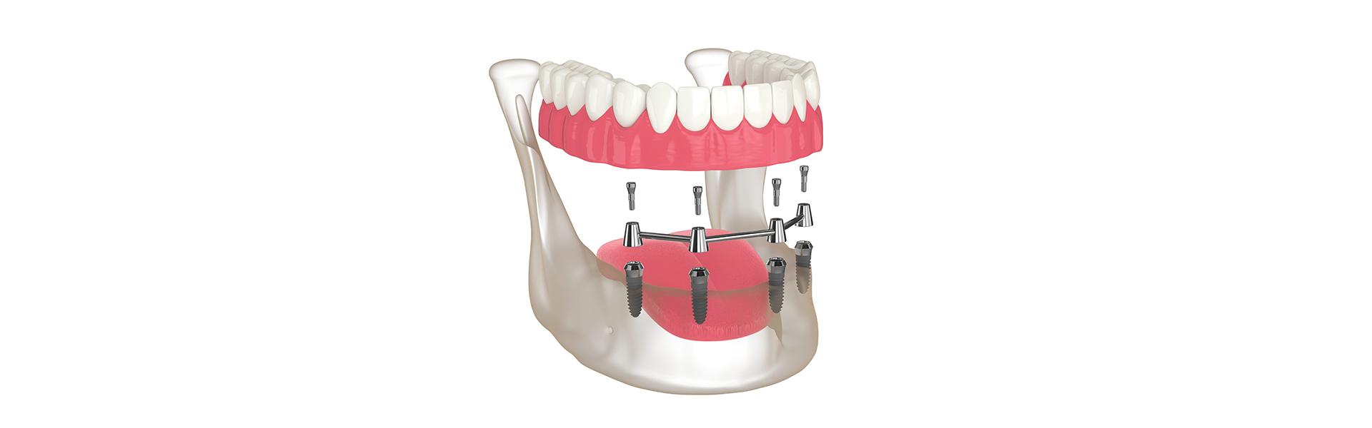 All-on-4 Dental Implants: A Permanent Solution for Missing Teeth