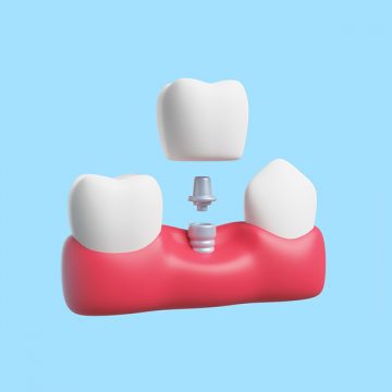 Understanding the Dental Implant Process at Largo Dental One