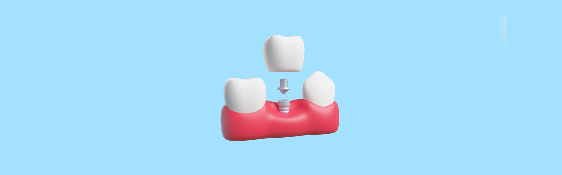 Understanding the Dental Implant Process at Largo Dental One