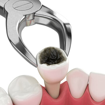 Benefits of Tooth Extraction: Improving Oral Health and Comfort