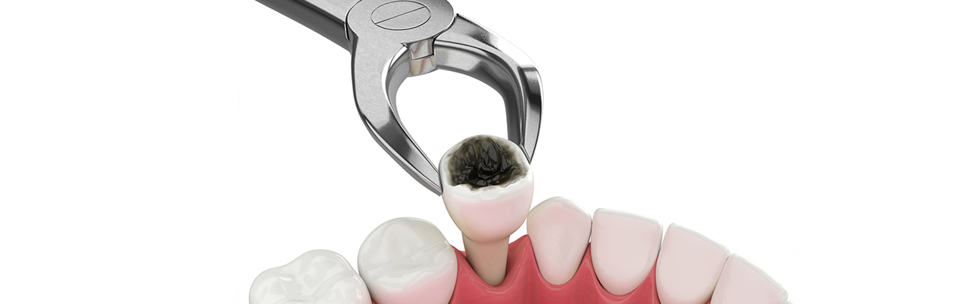 Benefits of Tooth Extraction: Improving Oral Health and Comfort